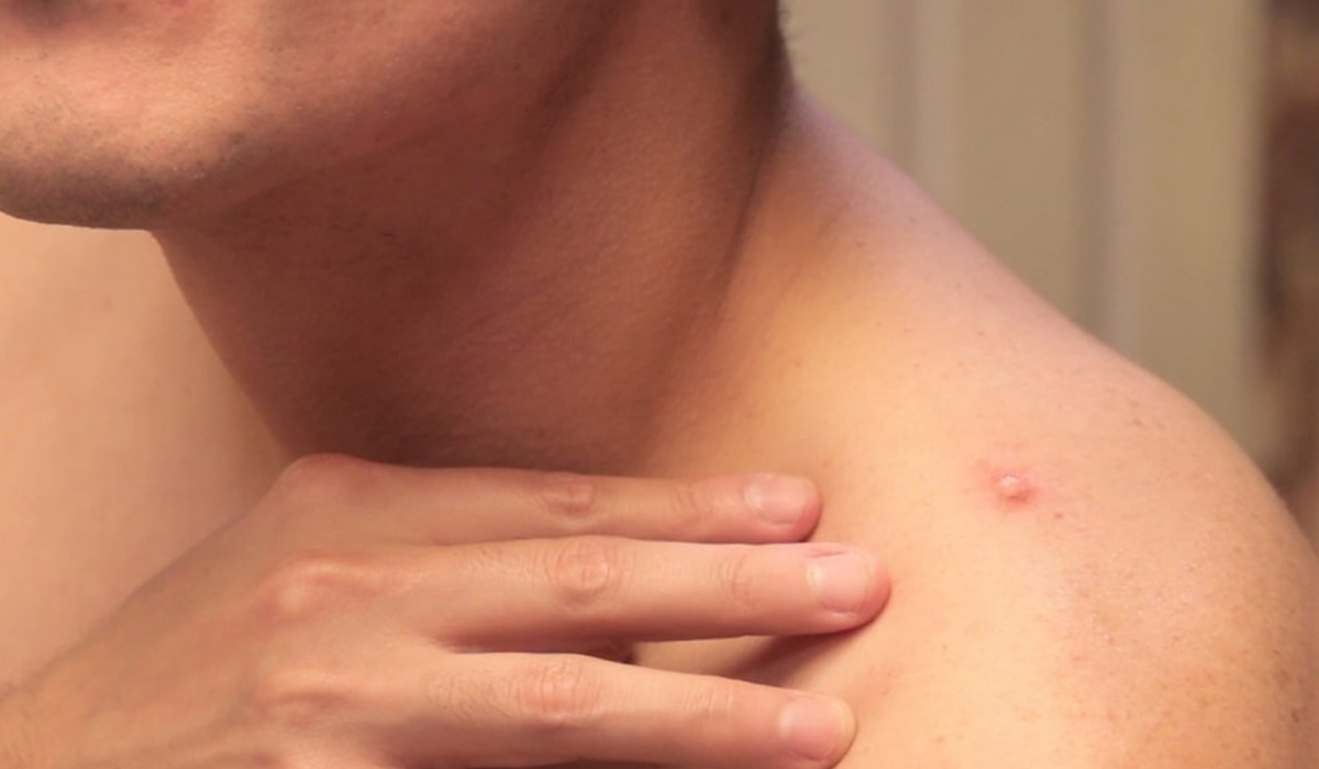 Kok Bisa Bisul Sering Muncul dan Berpindah Tempat? Mungkin Ini Penyebabnya