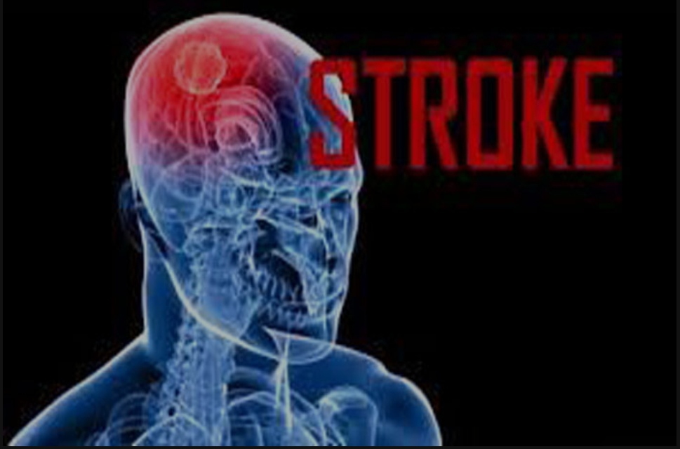 Waspada, Golongan Darah ini Rentan Terkena Stroke Diusia Muda