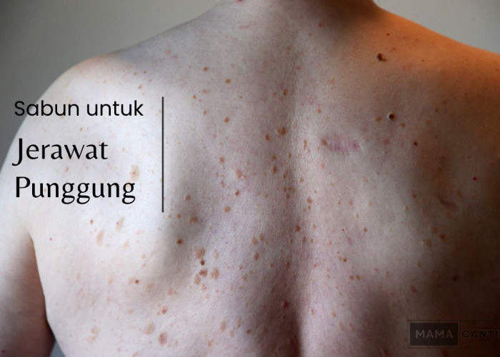Rekomendasi Sabun Jerawat Punggung yang Ampuh, Atasi Keluhan dan Bisa Dicoba