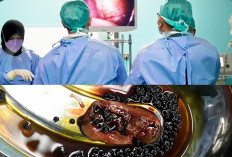 Apa Itu Penyumbatan Saluran Empedu yang Diderita Almarhum Alex Noerdin? Kenali Gejala dan Penyebabnya